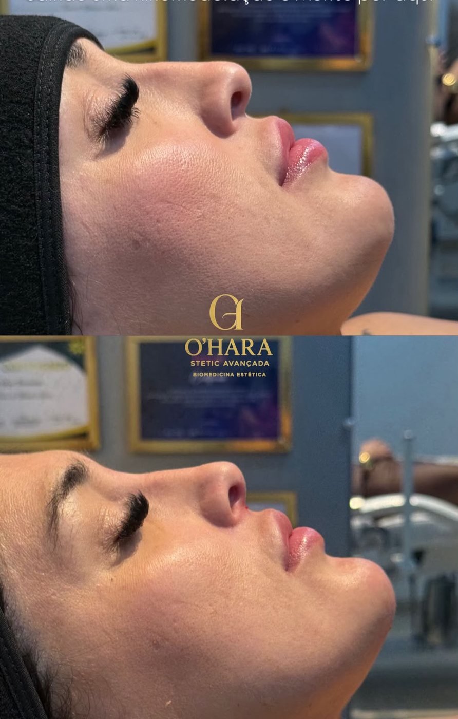 Perfiloplastia — resultado 2, antes e depois