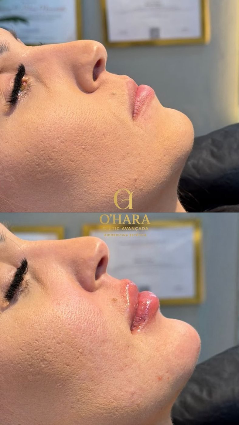Perfiloplastia — resultado 3, antes e depois